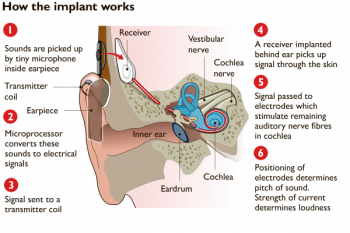 Cochlear Implant 350x233 